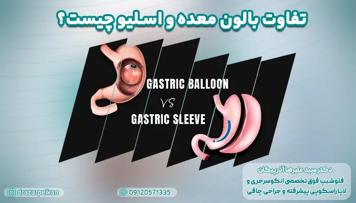 شروع پاسخ به سوال بالن معده بهتر است یا اسلیو