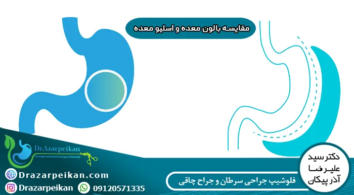 مقایسه بالون معده و اسلیو معده