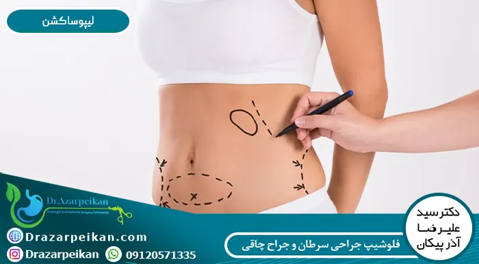 احتمال مرگ در اثر پیکر تراشی چقدر است؟