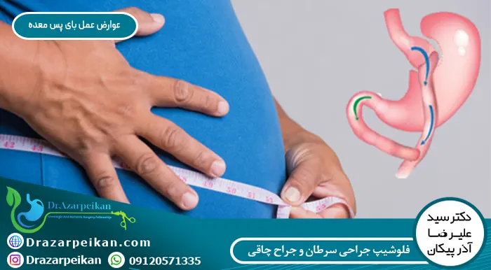 عوارض عمل بای پس معده خطرات طولانی مدت عمل بای پس معده بیشتر از عوارض کوتاه مدت آن است.
