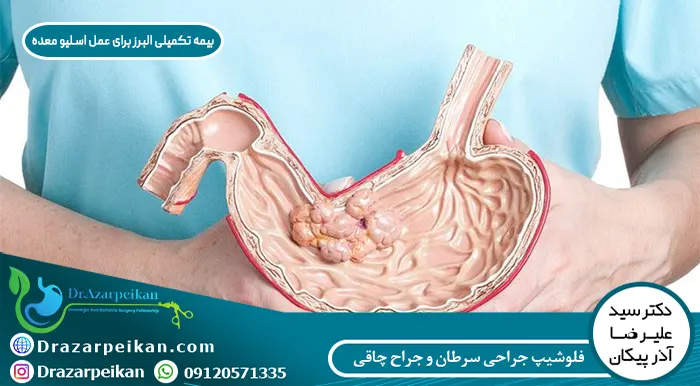 بیمه تکمیلی البرز برای عمل اسلیو معده بیمه تکمیلی البرز برای عمل اسلیو معده