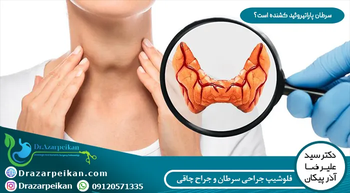 سرطان پاراتیروئید کشنده است سرطان پاراتیروئید کشنده است