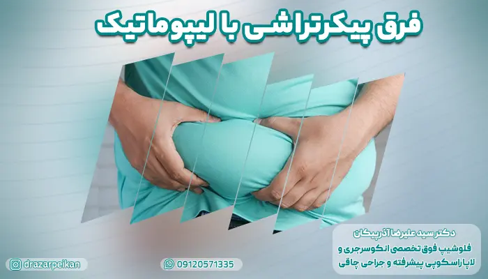 فرق پیکرتراشی با لیپوماتیک
