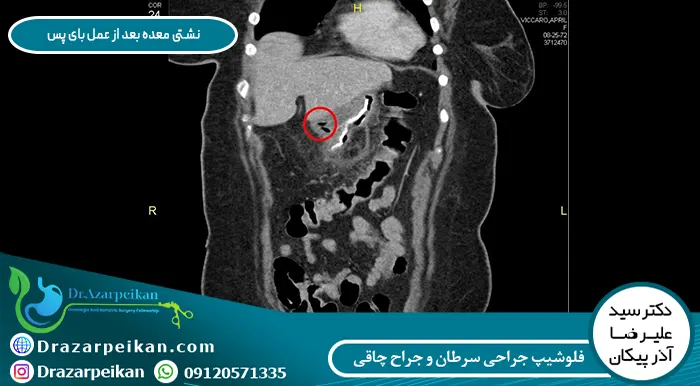 نشتی معده بعد از عمل بای پس نشتی معده بعد از عمل بای پس