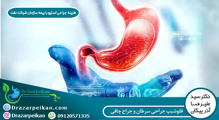 هزینه عمل اسلیو معده با بیمه تکمیلی شرکت نفت هزینه عمل اسلیو معده با بیمه تکمیلی شرکت نفت
