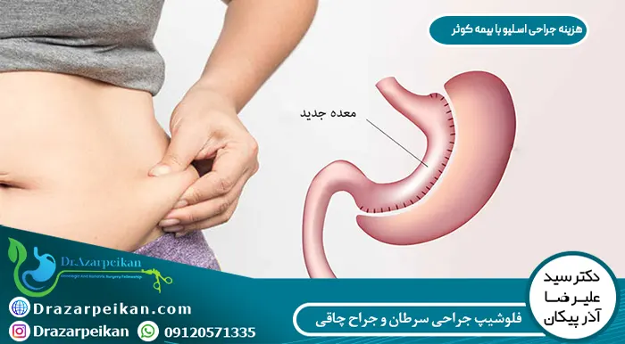 هزینه جراحی اسلیو با بیمه کوثر هزینه جراحی اسلیو با بیمه کوثر