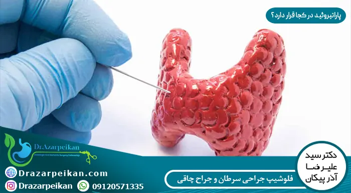 جای سرطان پاراتیروئید جای سرطان پاراتیروئید