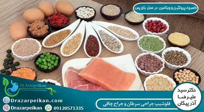 کمبود پروتئین و ویتامین در عمل بای پس کمبود پروتئین و ویتامین در عمل بای پس