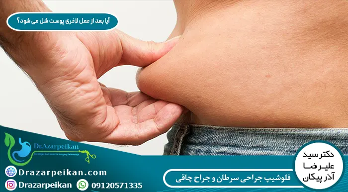 جلوگیری از افتادگی پوست شلی پوست بعد از عمل لاغری