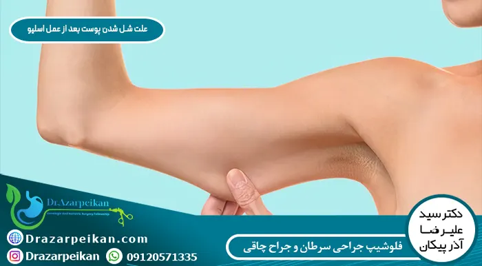 افتادگی پوست بعد از عمل اسلیو معده افتادگی پوست بعد از عمل اسلیو معده