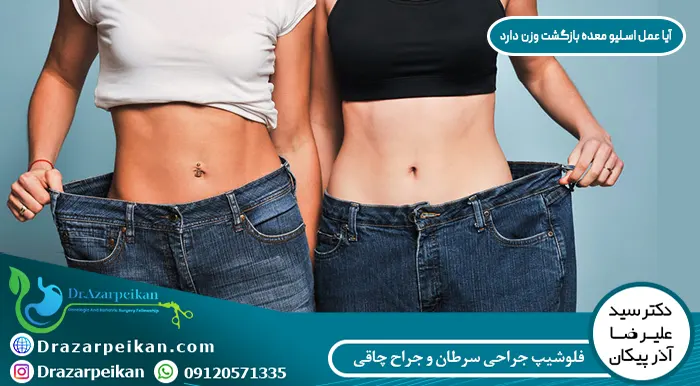 آیا عمل اسلیو معده برگشت دارد آیا عمل اسلیو معده برگشت دارد