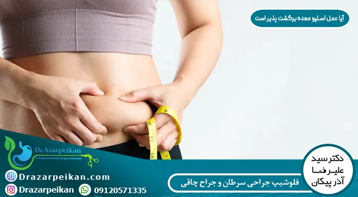 آیا عمل اسلیو معده برگشت پذیر است آیا عمل اسلیو معده برگشت پذیر است