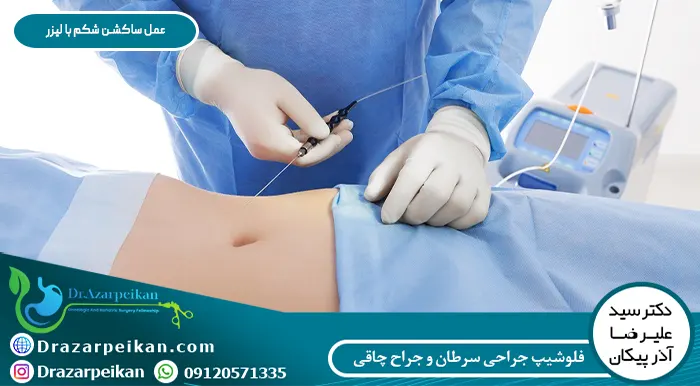 عمل ساکشن شکم با لیزر چگونه انجام می شود