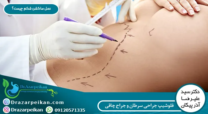 عمل ساکشن شکم چیست؟