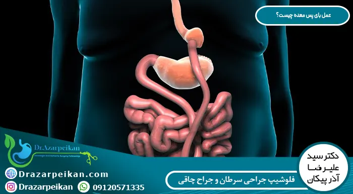 اهمیت توجه به محرک های روانی قبل از انجام عمل بای پس معده