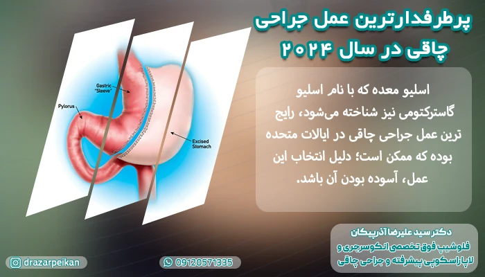 پرطرفدارترین عمل جراحی چاقی در سال 2024