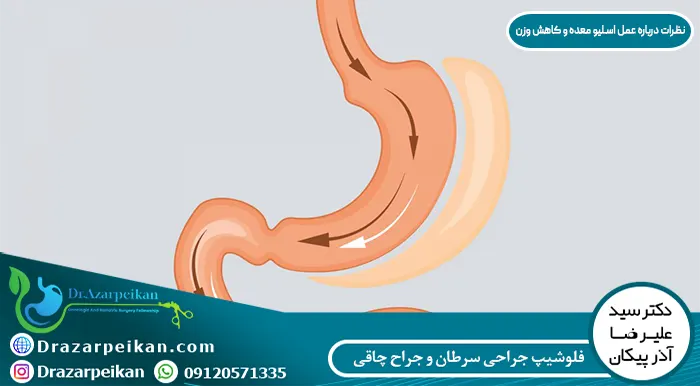 نظرات کسانی که عمل اسلیو معده انجام داده اند نظرات و تجریبات درباره عمل اسلیو معده