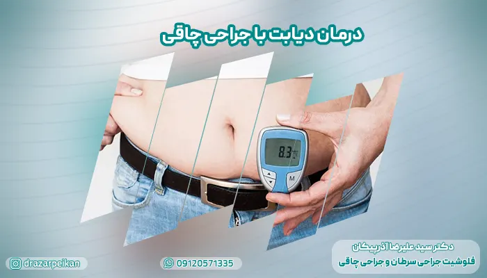 درمان دیابت با جراحی چاقی