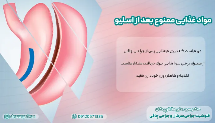 ممنوعیات بعد از عمل اسلیو معده ممنوعیات بعد از عمل اسلیو معده