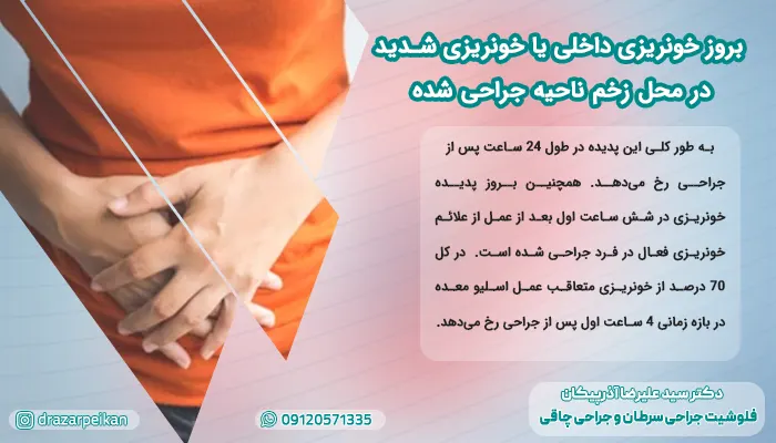 عمل اسلیو معده بروز خونریزی داخلی در محل زخم