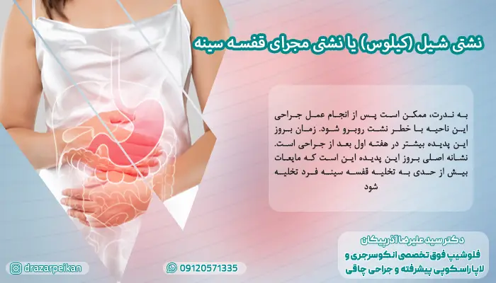 نشتی شیل (کیلوس) یا نشتی مجرای قفسه سینه