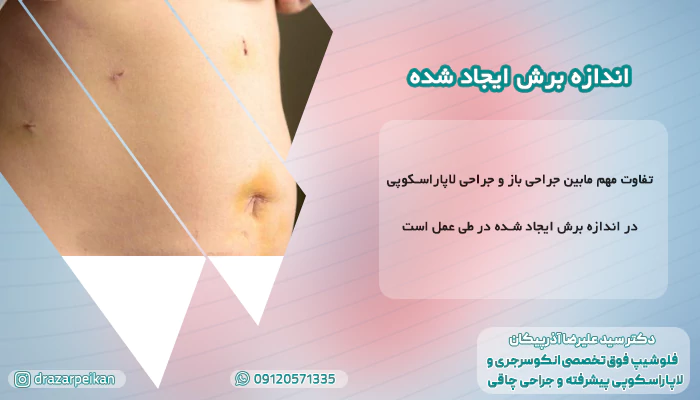 اندازه برش ایجاد شده در عمل فتق با لاپاراسکوپی بهتره یا عمل باز؟ + مزایا و معایب