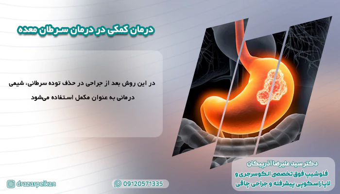 درمان کمکی در درمان سرطان معده درمان کمکی در درمان سرطان معده