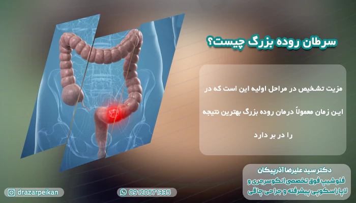 راه های درمان سرطان روده کدام اند؟