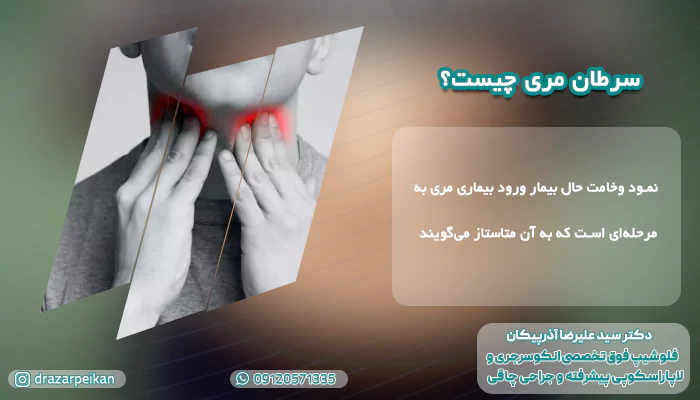 متاستاز سرطان مری سرطان مری چیست