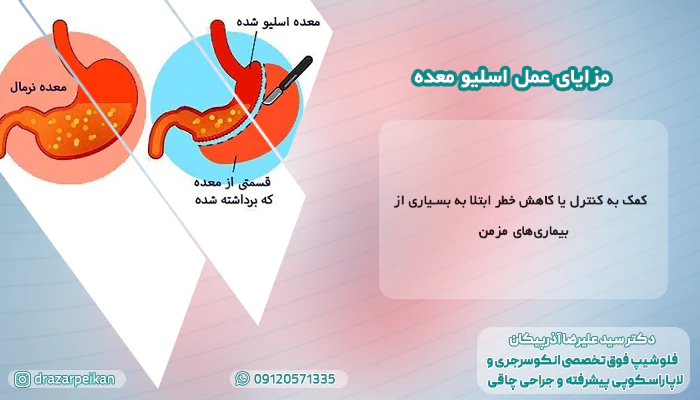 عمل اسلیو معده مزایای عمل اسلیو معده
