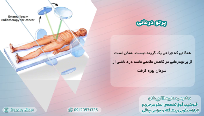 پرتو درمانی در درمان سرطان روده چقدر موثر است؟