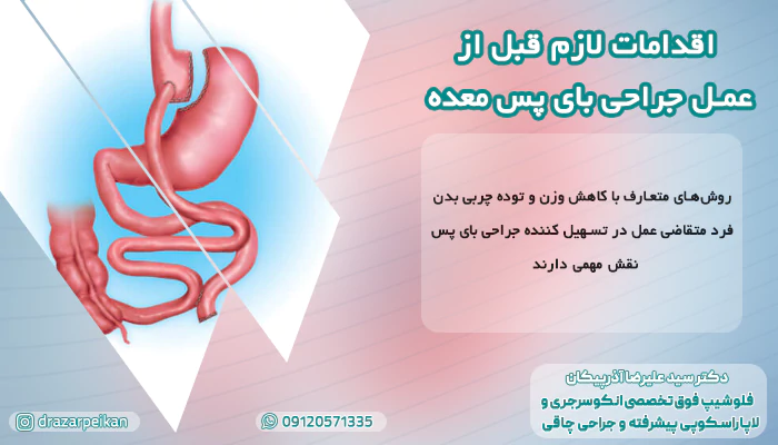 اقدامات لازم قبل از عمل جراحی بای پس معده اقدامات لازم قبل از عمل جراحی بای پس معده