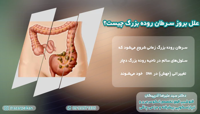 سرطان روده بزرگ چیست؟ علل بروز سرطان روده بزرگ