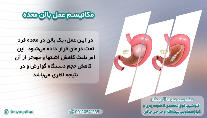 مکانیسم عمل بالن معده