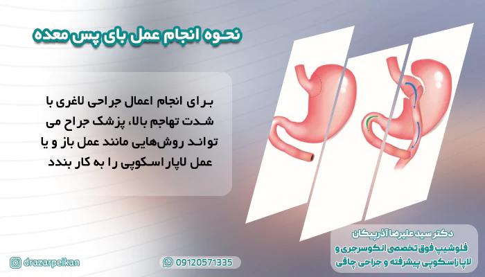 نحوه انجام عمل بای پس معده نحوه انجام عمل بای پس معده