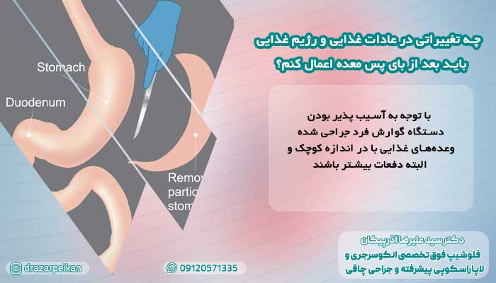 رژیم غذایی بعد از بای پس معده رژیم غذایی بعد از بای پس معده
