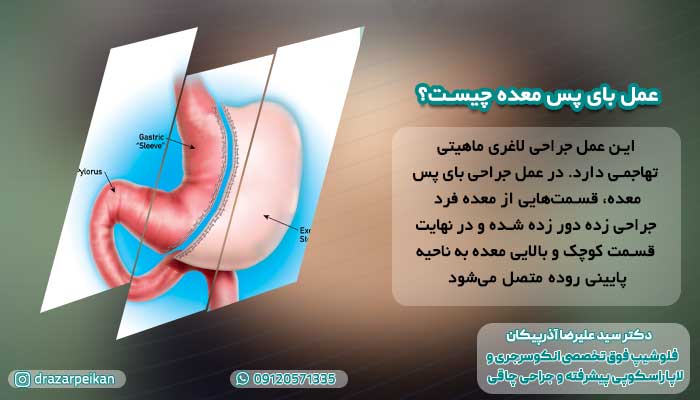 25 سوال متداول عمل بای پس معده 25 سوال متداول عمل بای پس معده