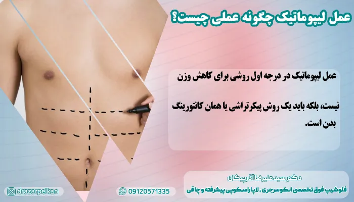 سیاه شدن پوست بعد از لیپوماتیک عمل لیپوماتیک چگونه عملی چیست؟