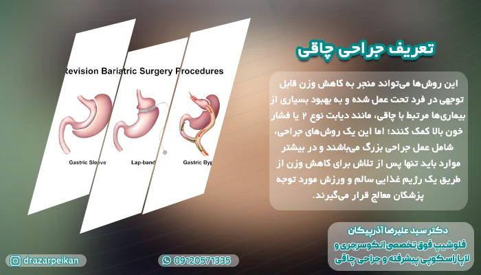 تعریف جراحی چاقی مروری بر انواع جراحی چاقی