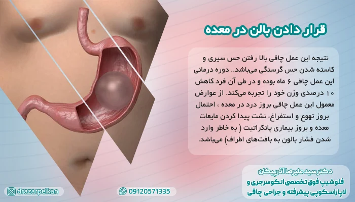 قرار دادن بالن در معده قرار دادن بالن در معده به عنوان یکی از انواع جرحای چاقی پر طرفدار شناخته می شود.