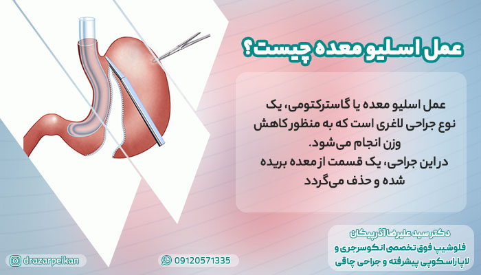 عمل اسلیو معده در چه زمانی ضرورت پیدا می کند؟