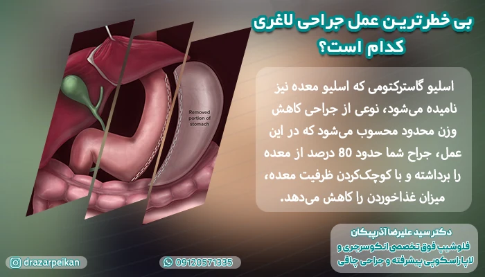 تصویر شماتیک اسلیو معده به عنوان بی خطر ترین عمل جراحی لاغری