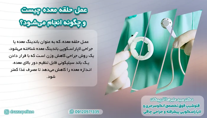 روش انجام عمل حلقه معده زیر نظر بهترین پزشک متخصص باندینگ معده