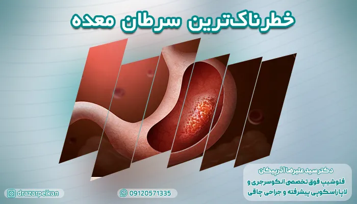 انواع سرطان معده کدام اند؟ وحشتناک ترین سرطان معده کدام است؟