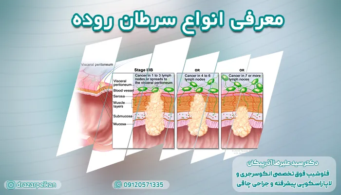 معرفی و آشنایی با انواع سرطان روده با کلینیک دکتر آذرپیکان