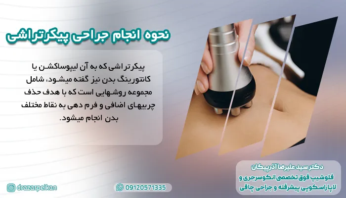 نحوه انجام جراحی پیکرتراشی به عنوان یکی از بهترین جراحی های پلاستیک و زیبایی زیر نظر دکتر آذرپیکان