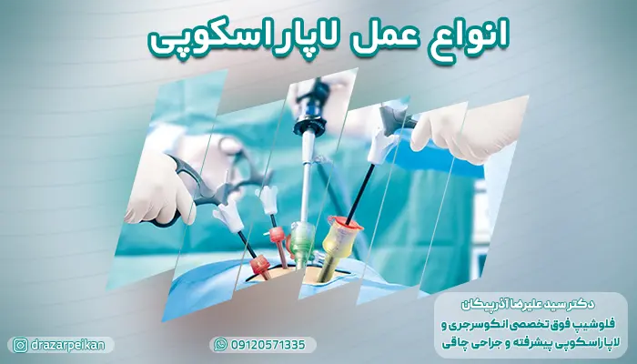 آشنایی با انواع جراحی لاپاراسکوپی