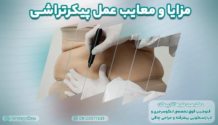 مزایا و معایب عمل پیکرتراشی