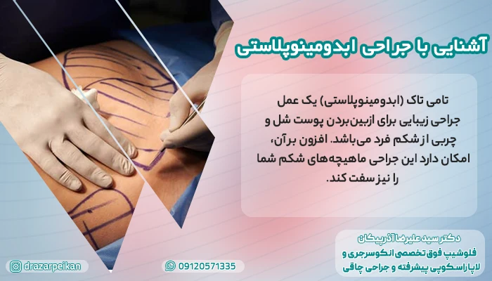 آشنایی با جراحی ابدومینوپلاستی زیر نظر دکتر آذرپیکان