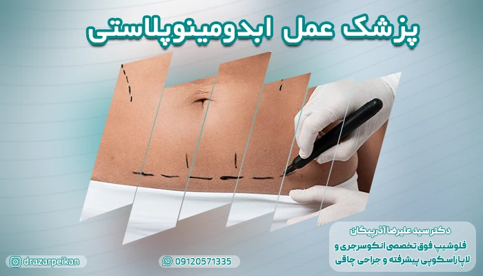 بهترین پزشک و متخصص ابدومینوپلاستی